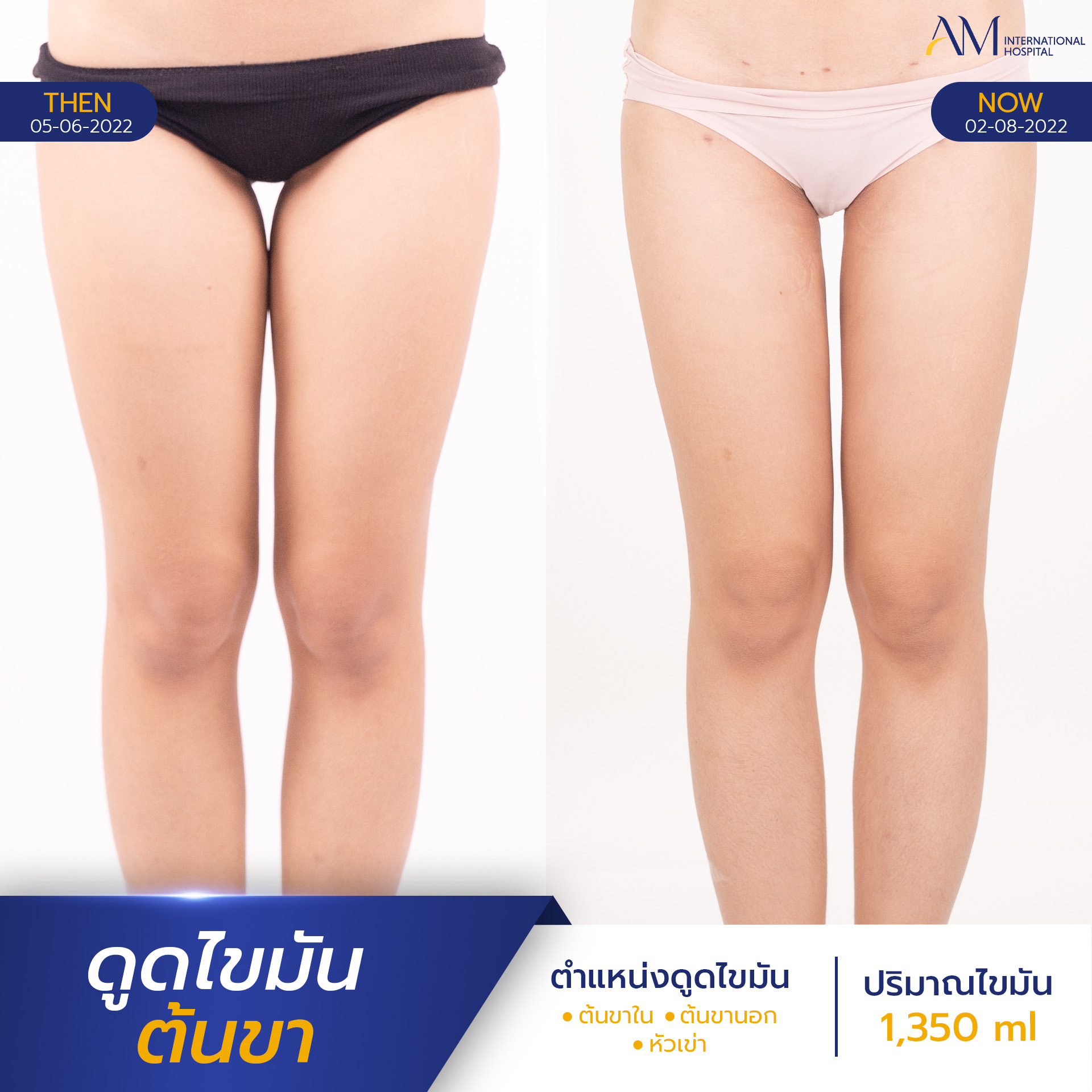 20250821-2025-08-18-AMINTER-BA-LIPO-Normal-ต้นขา-4294