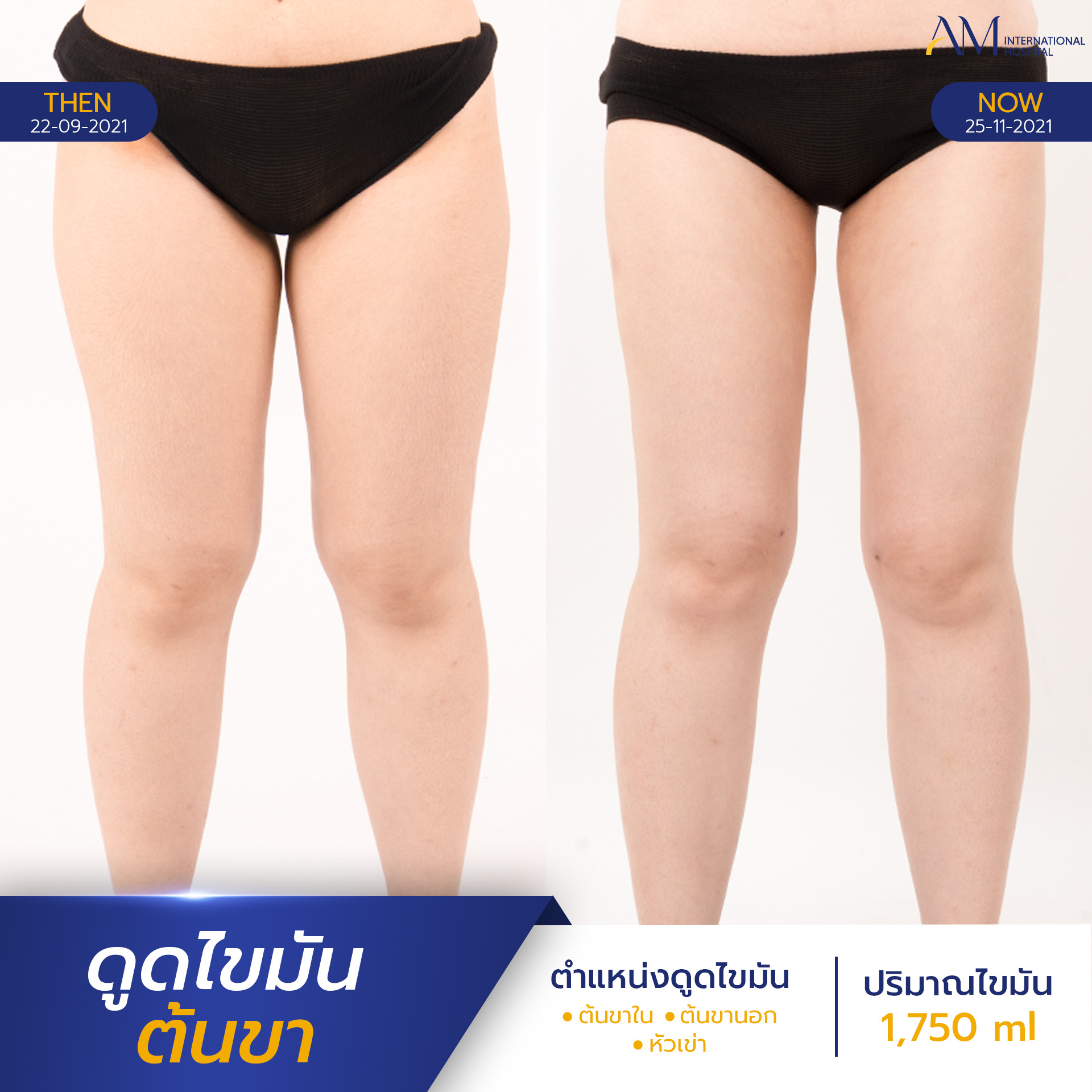 20250821-2025-08-18-AMINTER-BA-LIPO-Normal-ต้นขา-5851