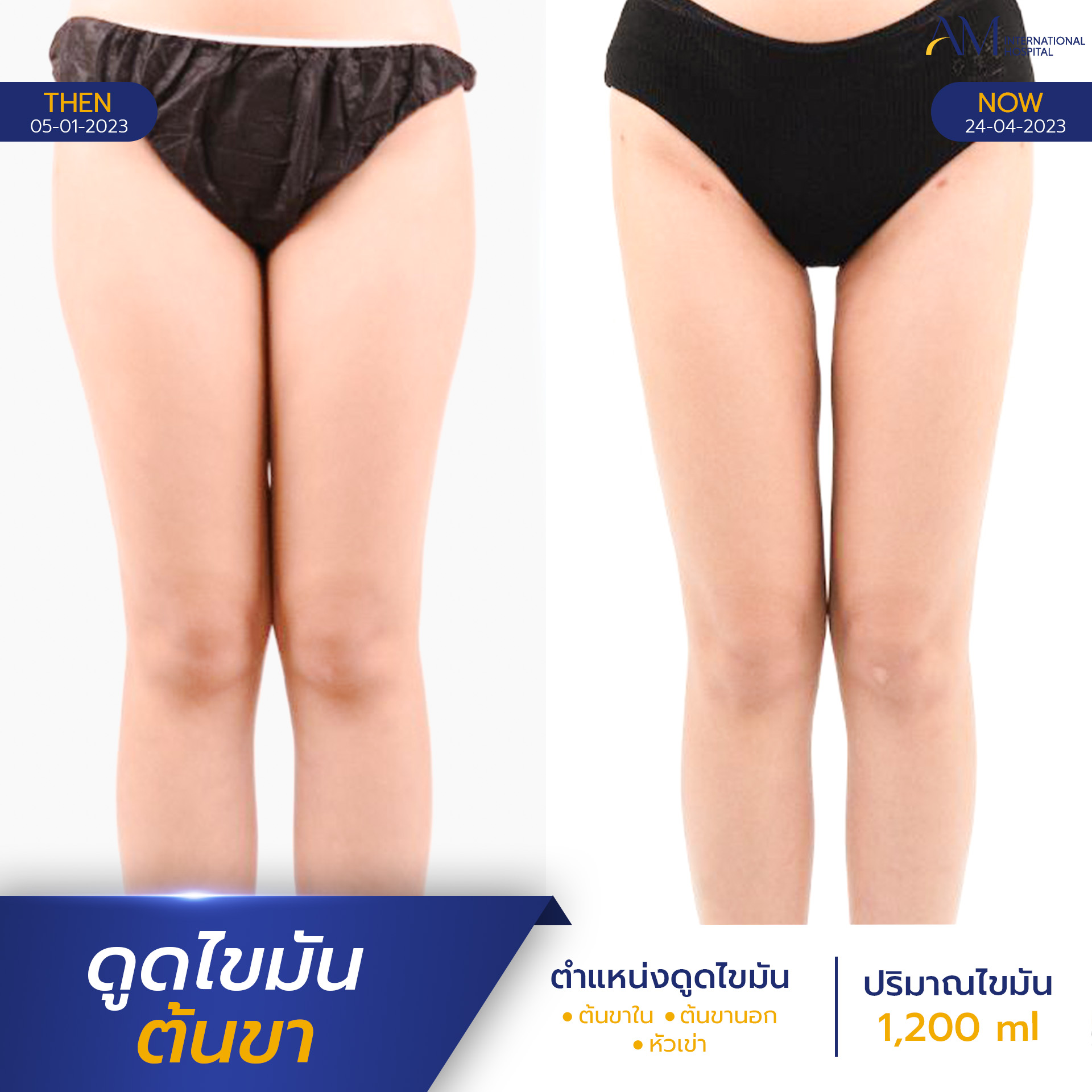 20250821-2025-08-18-AMINTER-BA-LIPO-Normal-ต้นขา-7989