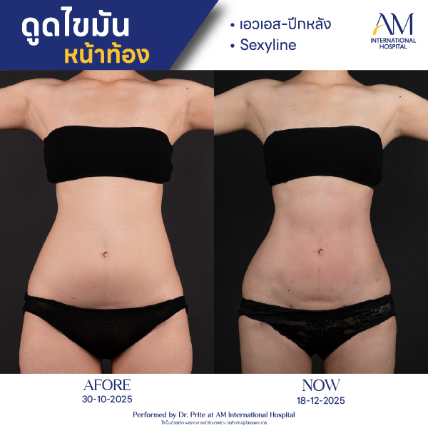 OP(ANGA)-รีวิวดูดไขมัน-sexyline-BA