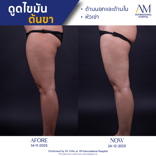 OP(ANGA)-รีวิวดูดไขมัน-ขา-BA-01