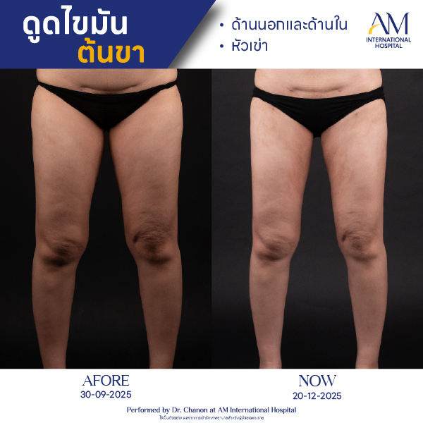 OP(ANGA)-รีวิวดูดไขมัน-ขา-BA-02