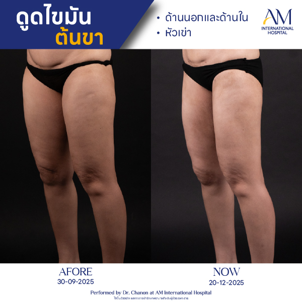 OP(ANGA)-รีวิวดูดไขมัน-ขา-BA-03