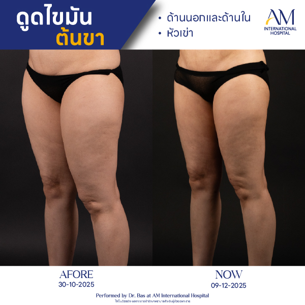 OP(ANGA)-รีวิวดูดไขมัน-ขา-BA-04