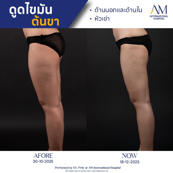 OP(ANGA)-รีวิวดูดไขมัน-ขา-BA-05