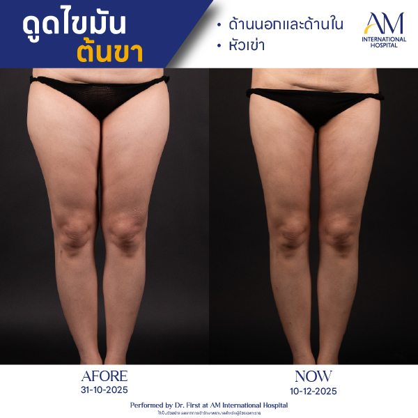 OP(ANGA)-รีวิวดูดไขมัน-ขา-BA-06