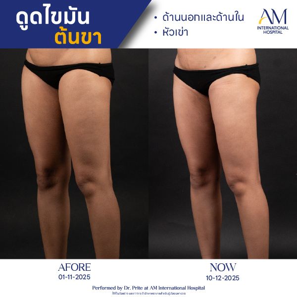 OP(ANGA)-รีวิวดูดไขมัน-ขา-BA-08