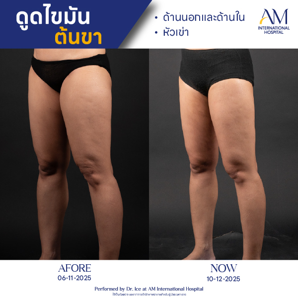 OP(ANGA)-รีวิวดูดไขมัน-ขา-BA-09