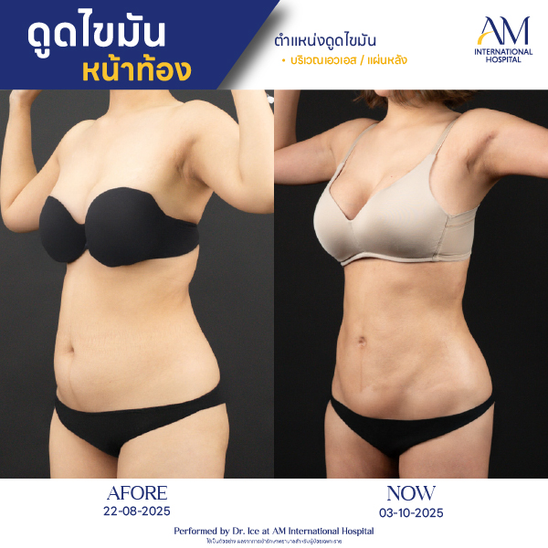 OP(ANGA)-รีวิวดูดไขมัน-ทั้งตัว-BA-01