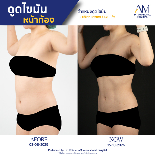 OP(ANGA)-รีวิวดูดไขมัน-ทั้งตัว-BA-02