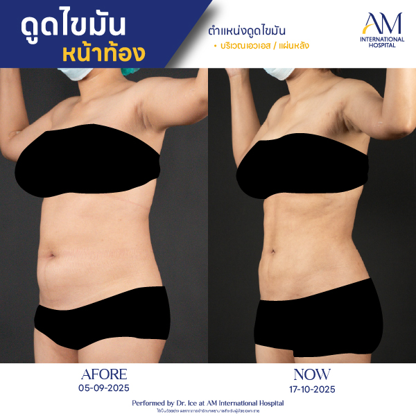 OP(ANGA)-รีวิวดูดไขมัน-ทั้งตัว-BA-04