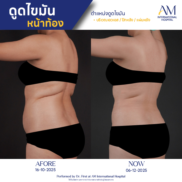 OP(ANGA)-รีวิวดูดไขมัน-ทั้งตัว-BA-05