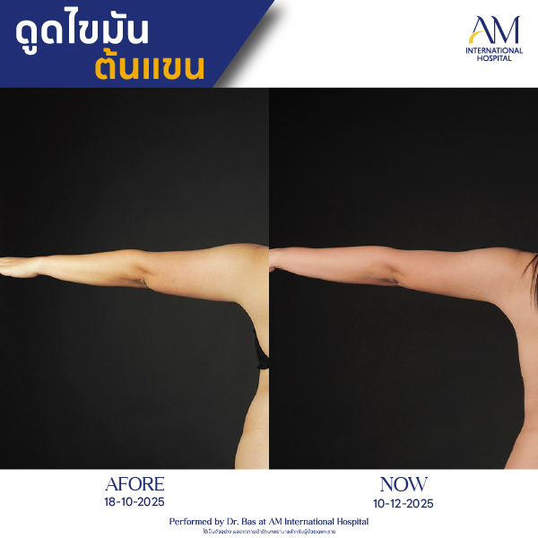 OP(ANGA)-รีวิวดูดไขมัน-แขน-BA-01