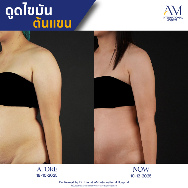 OP(ANGA)-รีวิวดูดไขมัน-แขน-BA-02