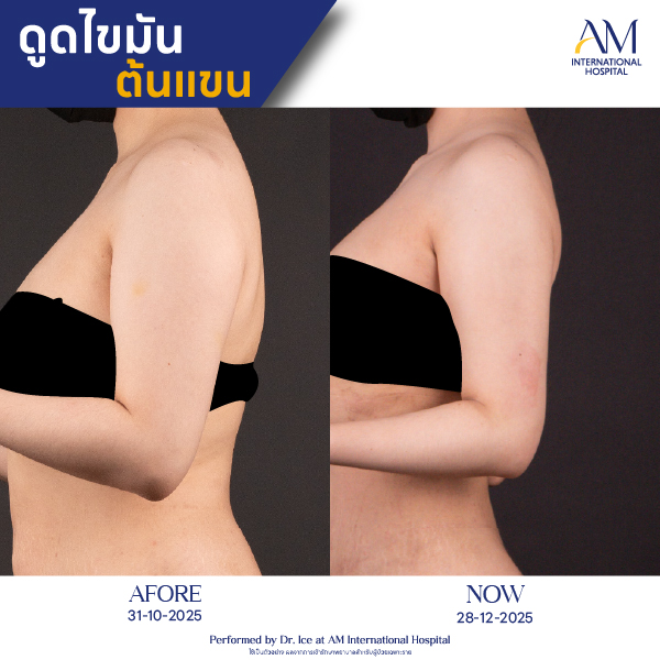 OP(ANGA)-รีวิวดูดไขมัน-แขน-BA-03