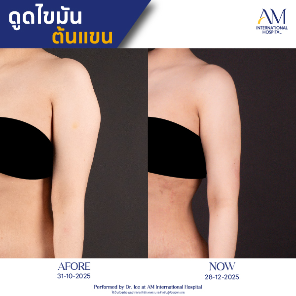 OP(ANGA)-รีวิวดูดไขมัน-แขน-BA-04