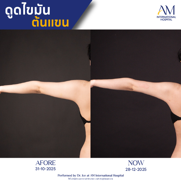 OP(ANGA)-รีวิวดูดไขมัน-แขน-BA-05