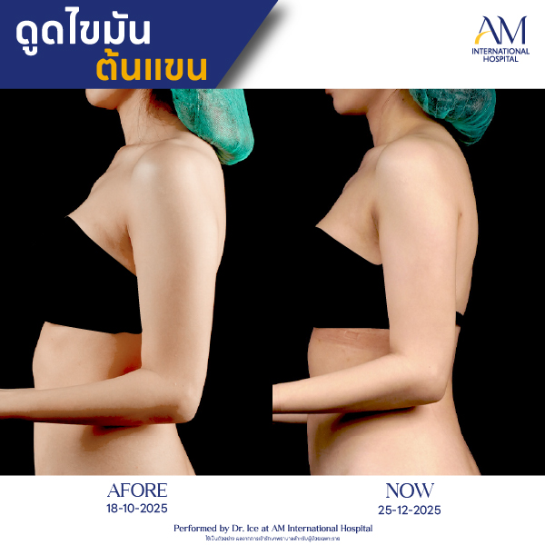 OP(ANGA)-รีวิวดูดไขมัน-แขน-BA-06