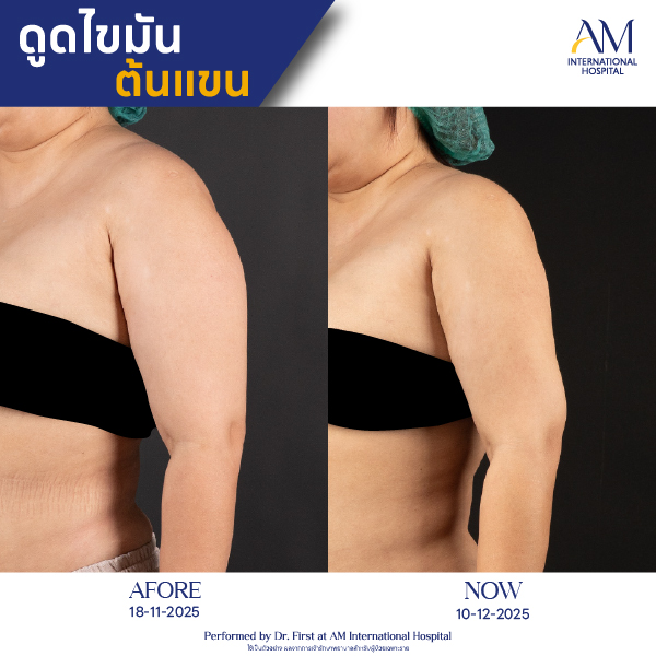 OP(ANGA)-รีวิวดูดไขมัน-แขน-BA-08