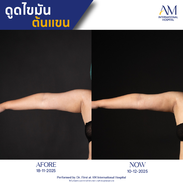 OP(ANGA)-รีวิวดูดไขมัน-แขน-BA-09