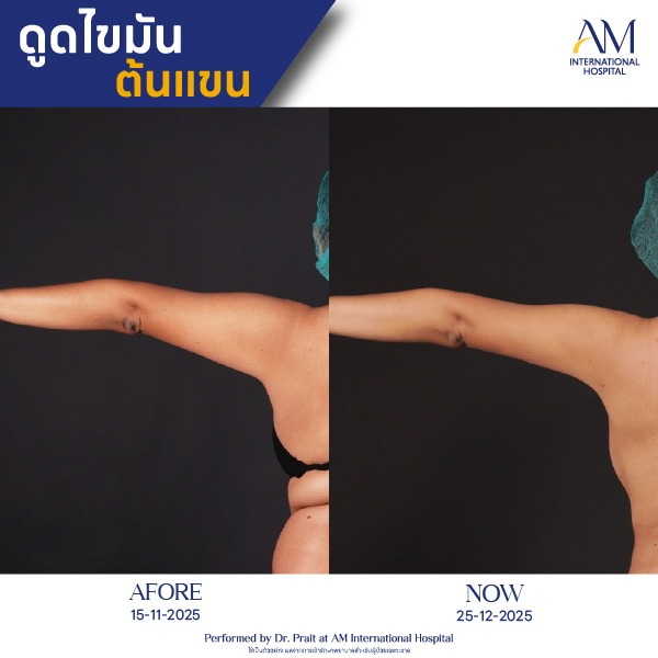 OP(ANGA)-รีวิวดูดไขมัน-แขน-BA-10