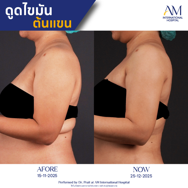 OP(ANGA)-รีวิวดูดไขมัน-แขน-BA-11