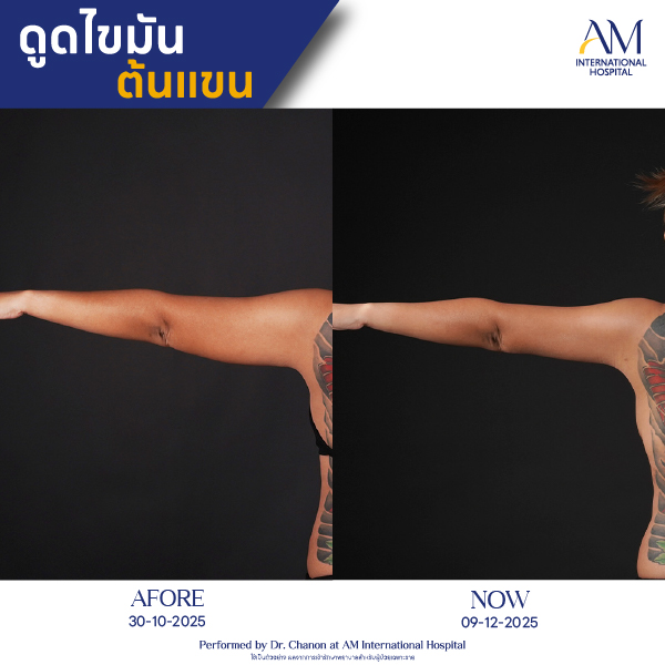 OP(ANGA)-รีวิวดูดไขมัน-แขน-BA-12