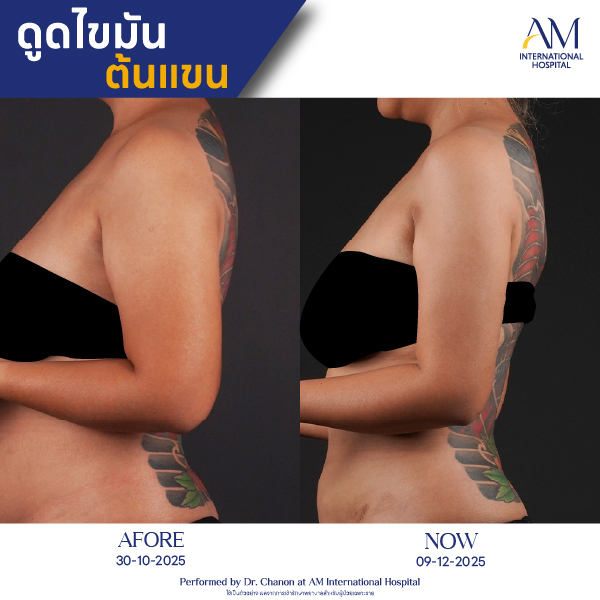 OP(ANGA)-รีวิวดูดไขมัน-แขน-BA-13