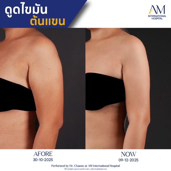 OP(ANGA)-รีวิวดูดไขมัน-แขน-BA-14