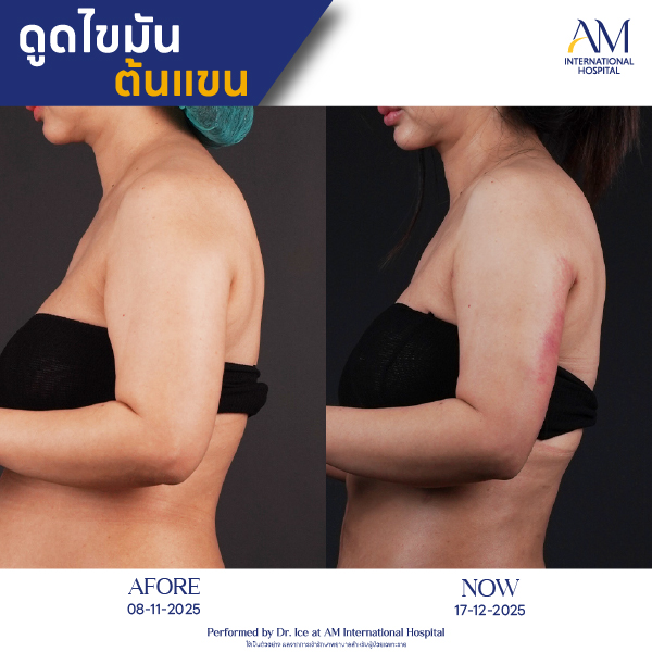 OP(ANGA)-รีวิวดูดไขมัน-แขน-BA-16