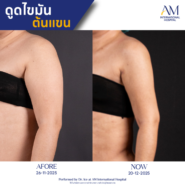 OP(ANGA)-รีวิวดูดไขมัน-แขน-BA-18