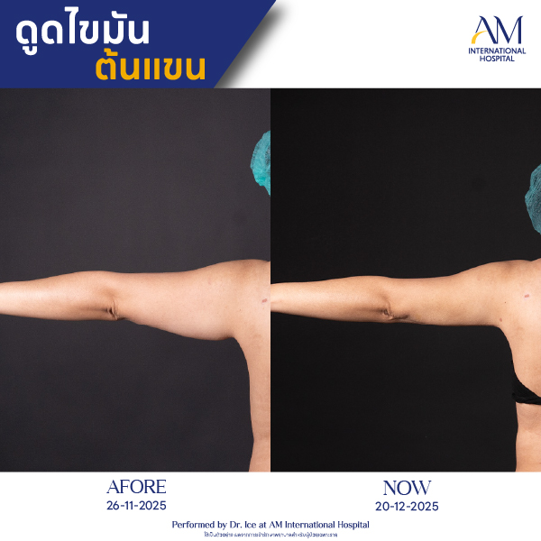 OP(ANGA)-รีวิวดูดไขมัน-แขน-BA-19