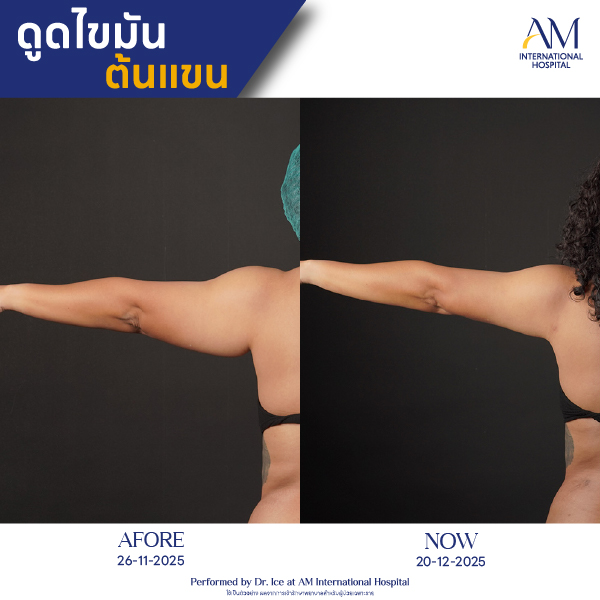 OP(ANGA)-รีวิวดูดไขมัน-แขน-BA-20