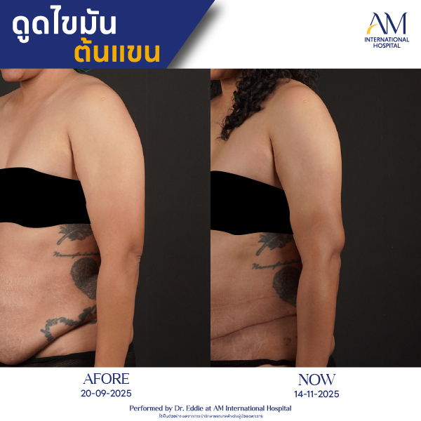 OP(ANGA)-รีวิวดูดไขมัน-แขน-BA-21