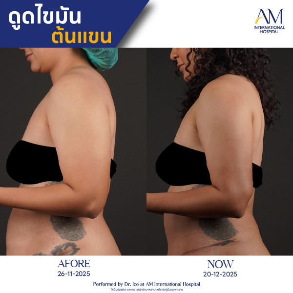 OP(ANGA)-รีวิวดูดไขมัน-แขน-BA-22