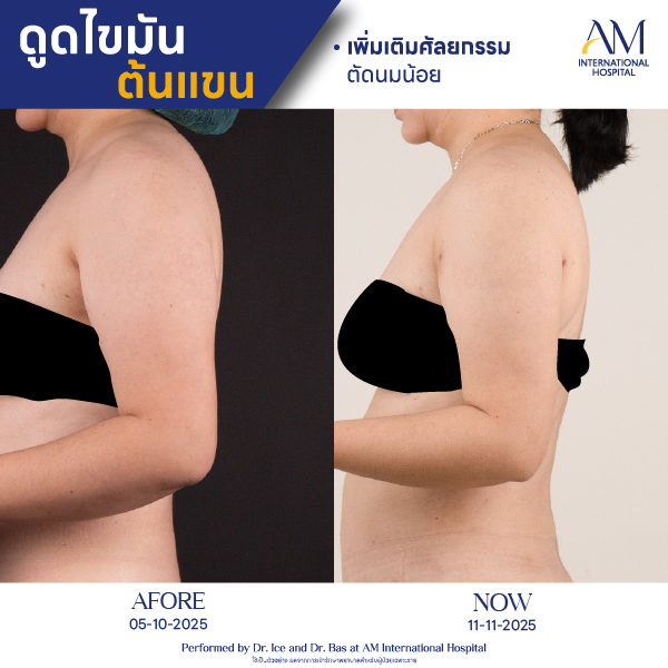 OP(ANGA)-รีวิวดูดไขมัน-แขน-BA-23