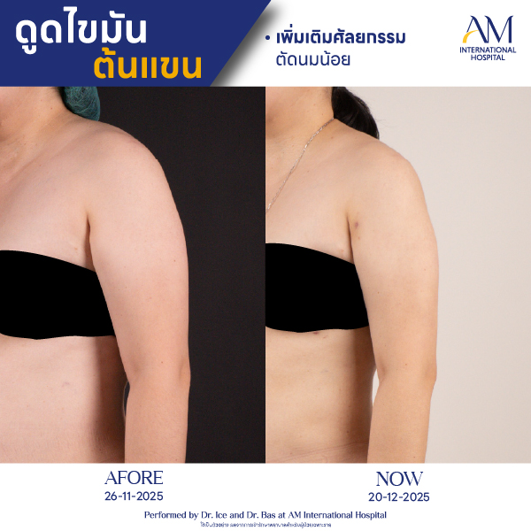 OP(ANGA)-รีวิวดูดไขมัน-แขน-BA-24