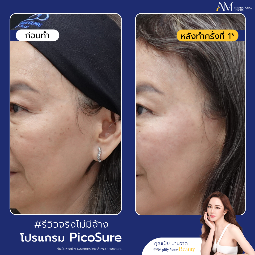 BA PicoSure_1