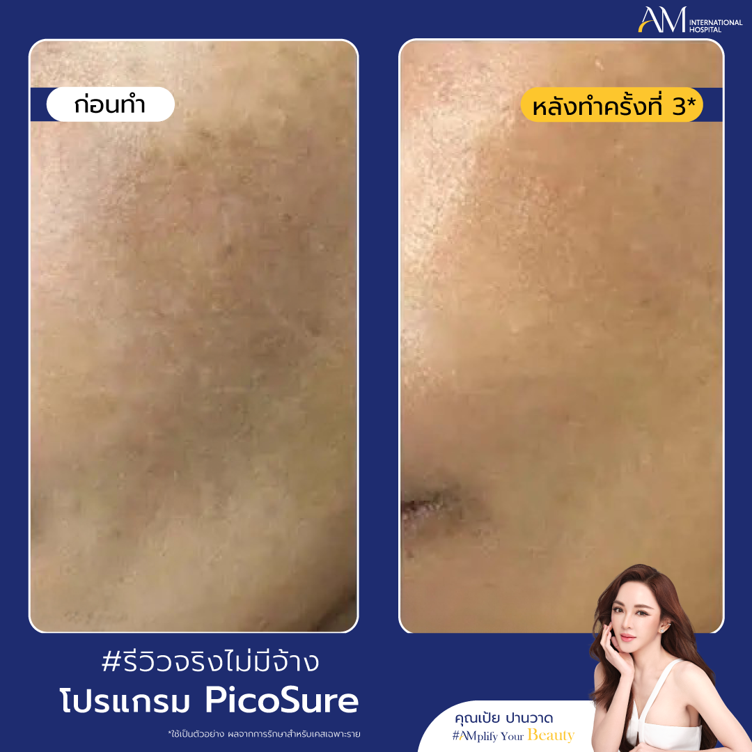 BA PicoSure_4