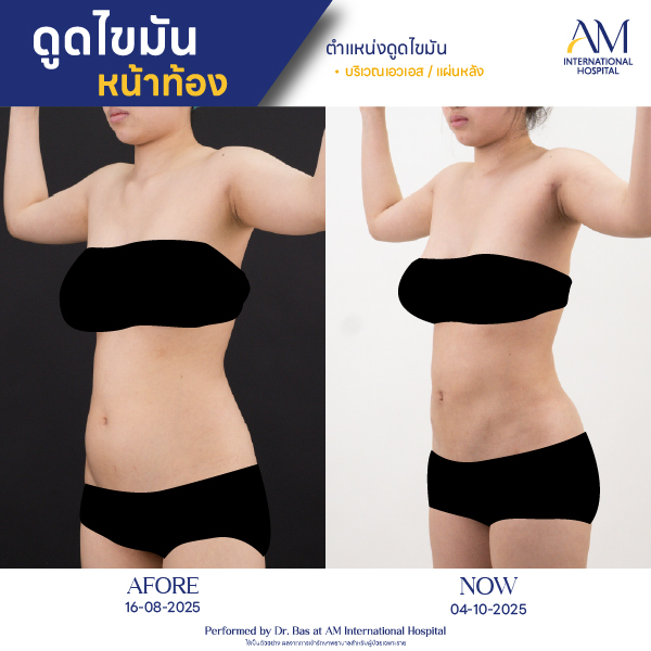 OP(ANGA)-รีวิวดูดไขมัน-ทั้งตัว-BA-03