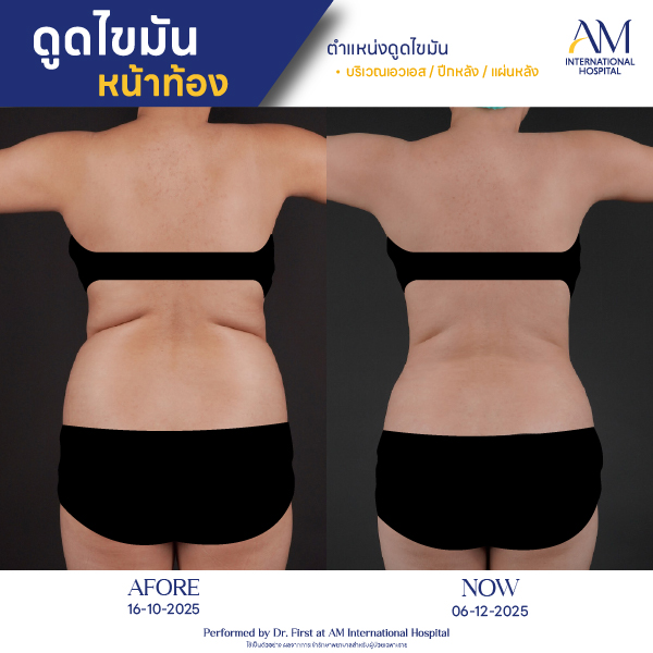 OP(ANGA)-รีวิวดูดไขมัน-ทั้งตัว-BA-06