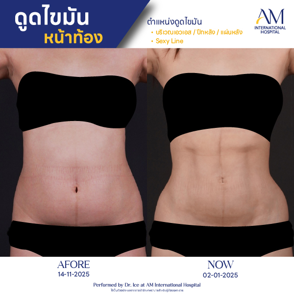 OP(ANGA)-รีวิวดูดไขมัน-ทั้งตัว-BA-08