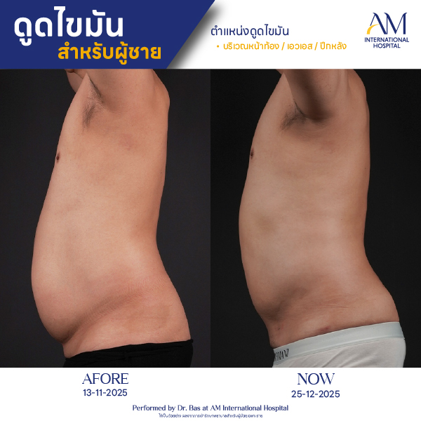 OP(ANGA)-รีวิวดูดไขมัน-ผู้ชาย-BA-01