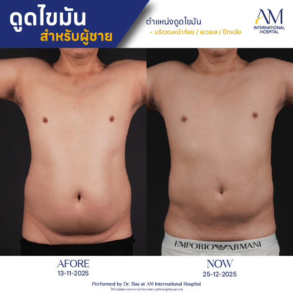 OP(ANGA)-รีวิวดูดไขมัน-ผู้ชาย-BA-02