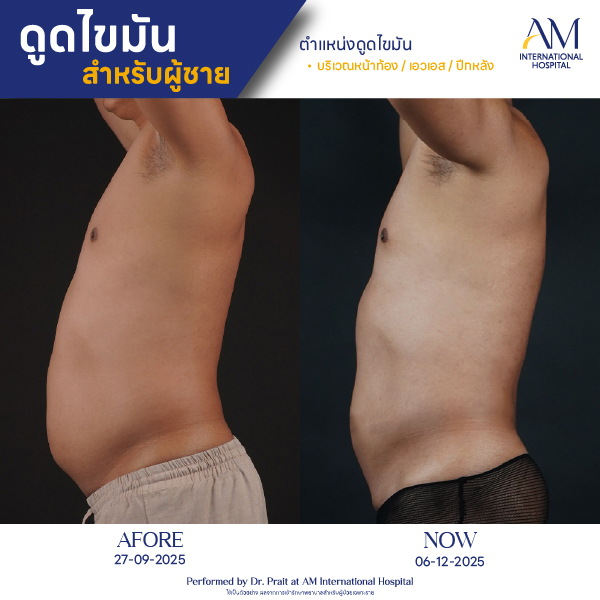 OP(ANGA)-รีวิวดูดไขมัน-ผู้ชาย-BA-03