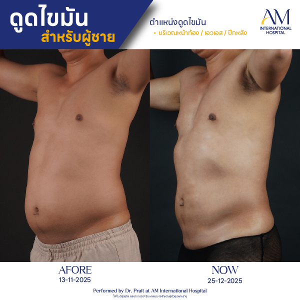 OP(ANGA)-รีวิวดูดไขมัน-ผู้ชาย-BA-04