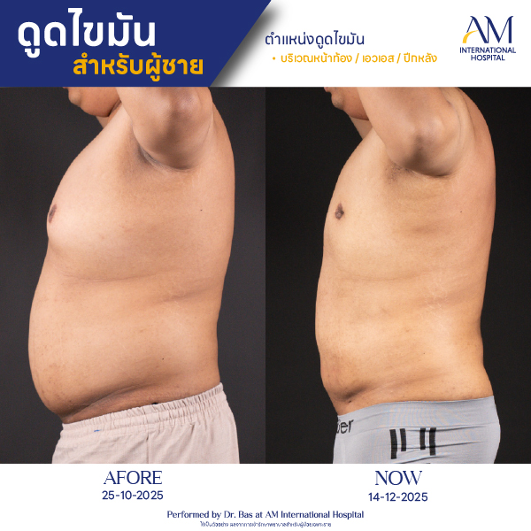 OP(ANGA)-รีวิวดูดไขมัน-ผู้ชาย-BA-05