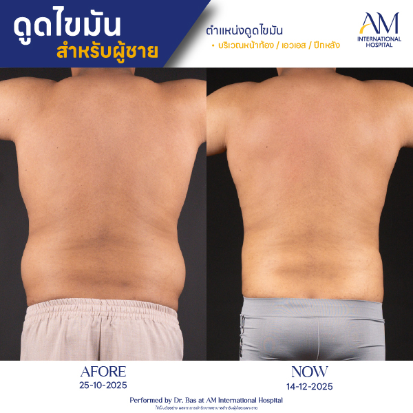 OP(ANGA)-รีวิวดูดไขมัน-ผู้ชาย-BA-06