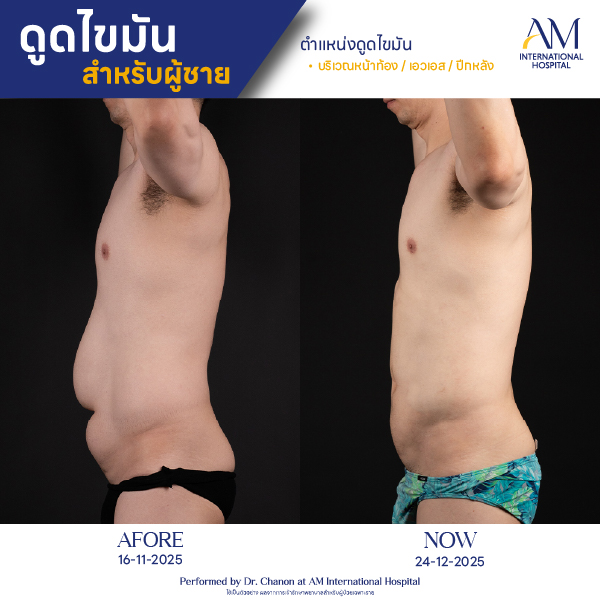 OP(ANGA)-รีวิวดูดไขมัน-ผู้ชาย-BA-07