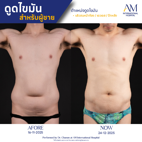 OP(ANGA)-รีวิวดูดไขมัน-ผู้ชาย-BA-08